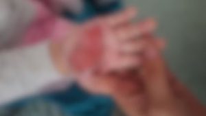 Polícia investiga mulher que queimou a mão da enteada para castigá-la em SC