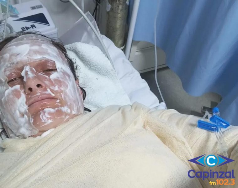 Explosão em churrasqueira deixa moradora de Capinzal ferida