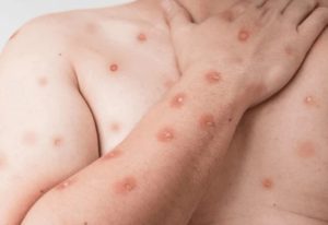 Casos de mpox avançam neste início de ano no Brasil