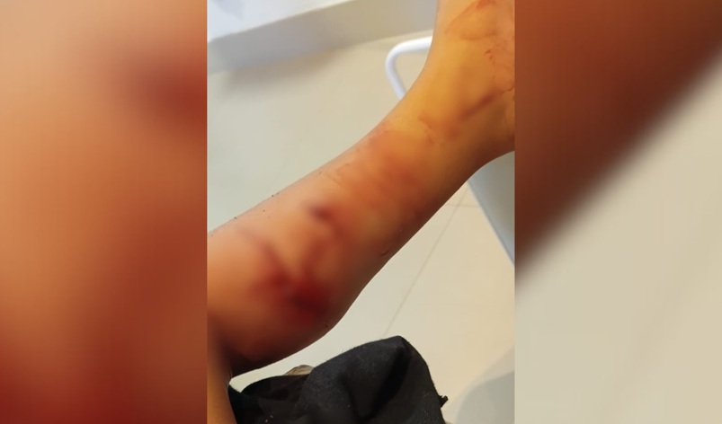 Criança de 3 anos é atacada por cachorro a caminho da creche no Oeste