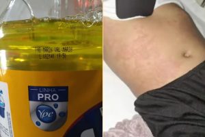 Menina é internada por intoxicação após provável uso de Ypê
