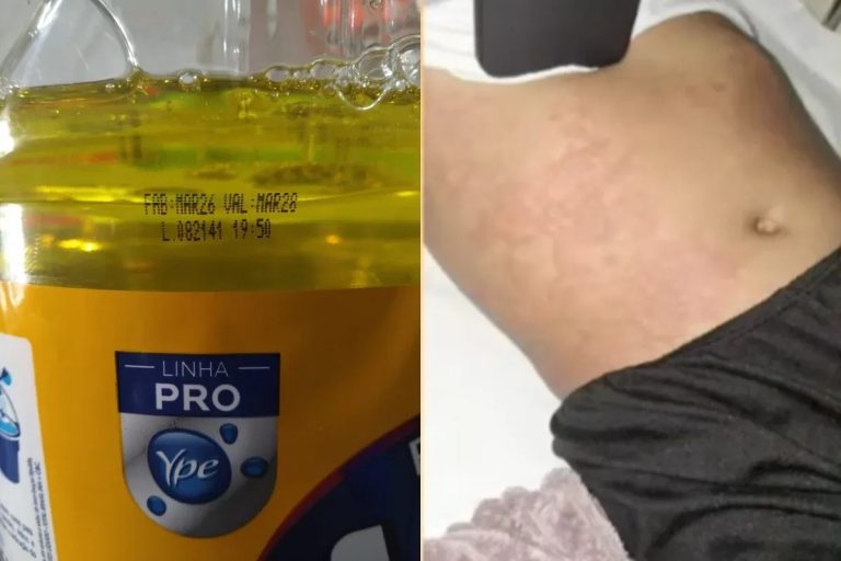 Menina é internada por intoxicação após provável uso de Ypê