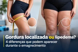 Gordura localizada ou lipedema? 4 diferenças que podem aparecer durante o emagrecimento