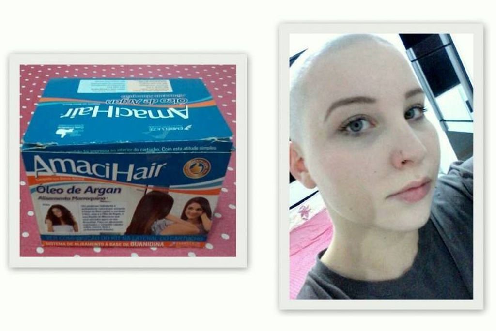 Jovem perde os cabelos ao usar produto para alisamento e hidratação