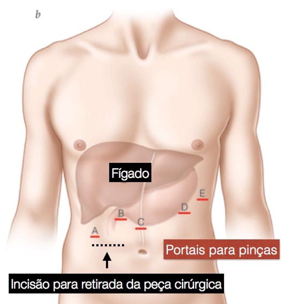 Equipe de oncologia do HUST realiza nova técnica cirúrgica
