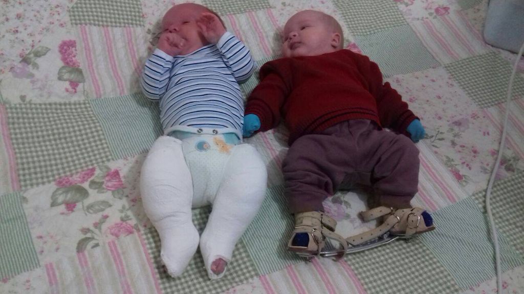 Família busca ajuda para bebês gêmeos realizarem cirurgia
