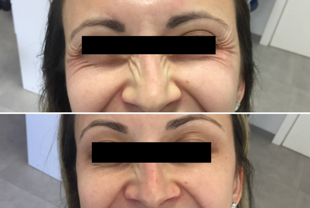 Bem Estar – Novidade no uso da Toxina Botulínica