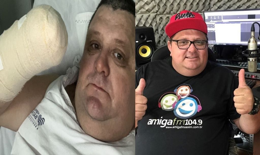 Humorista concordiense tem mão amputada após acidente com fogo de artifício