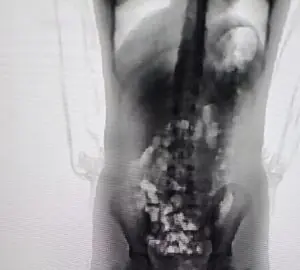 Adolescente de 13 anos é flagrada com 32 porções de skank escondidas no corpo em presídio de SC