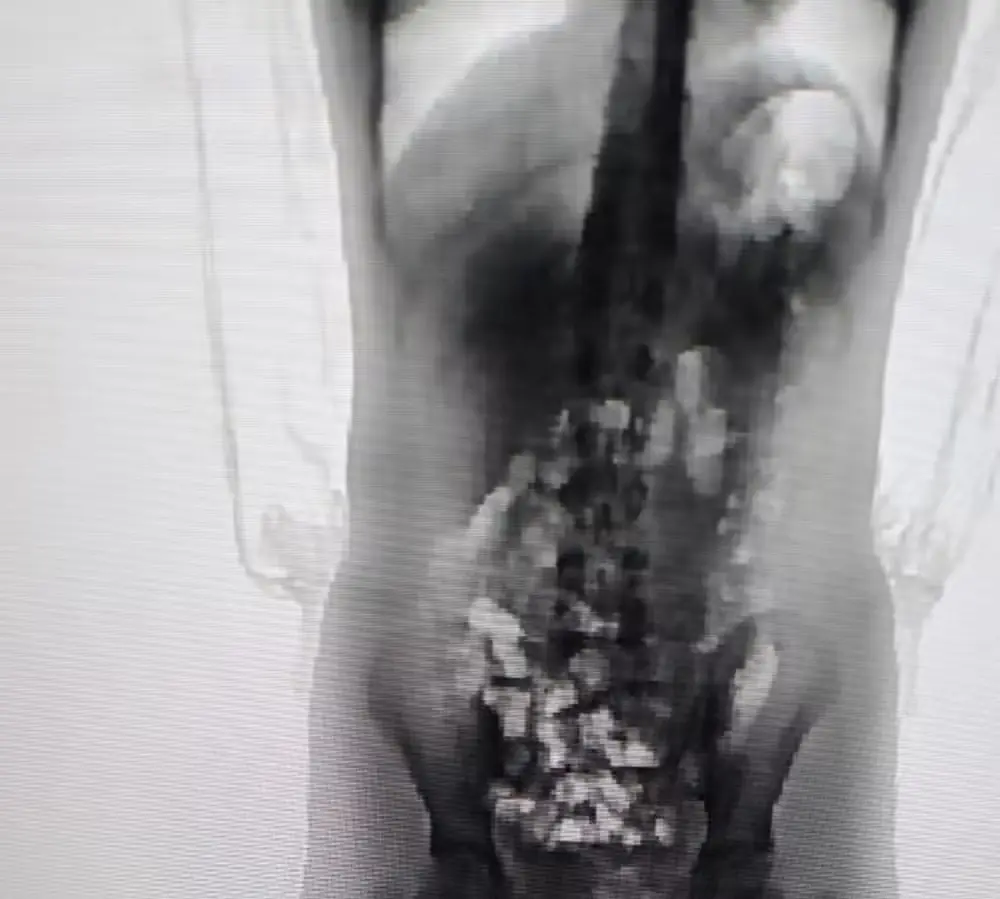 Adolescente de 13 anos é flagrada com 32 porções de skank escondidas no corpo em presídio de SC
